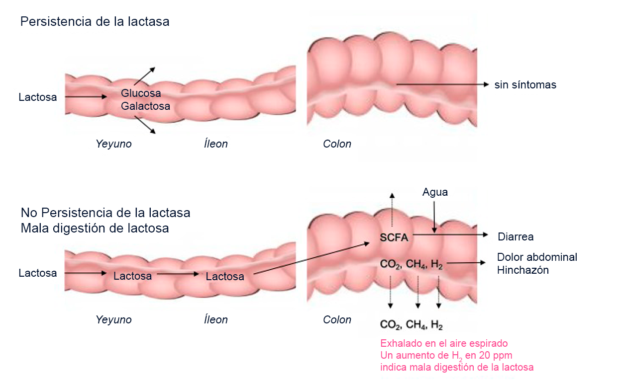 Intolerancia a la Lactosa: ¿Qué es, Tipos, Síntomas, Cómo Diagnosticar y Mucho Más!