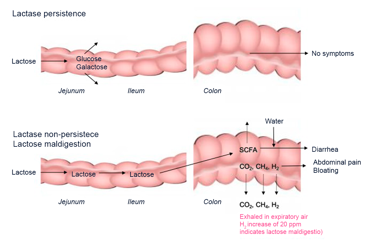 Lactose Intolerance: What It Is, Types, Symptoms, How to Diagnose, and Much More!