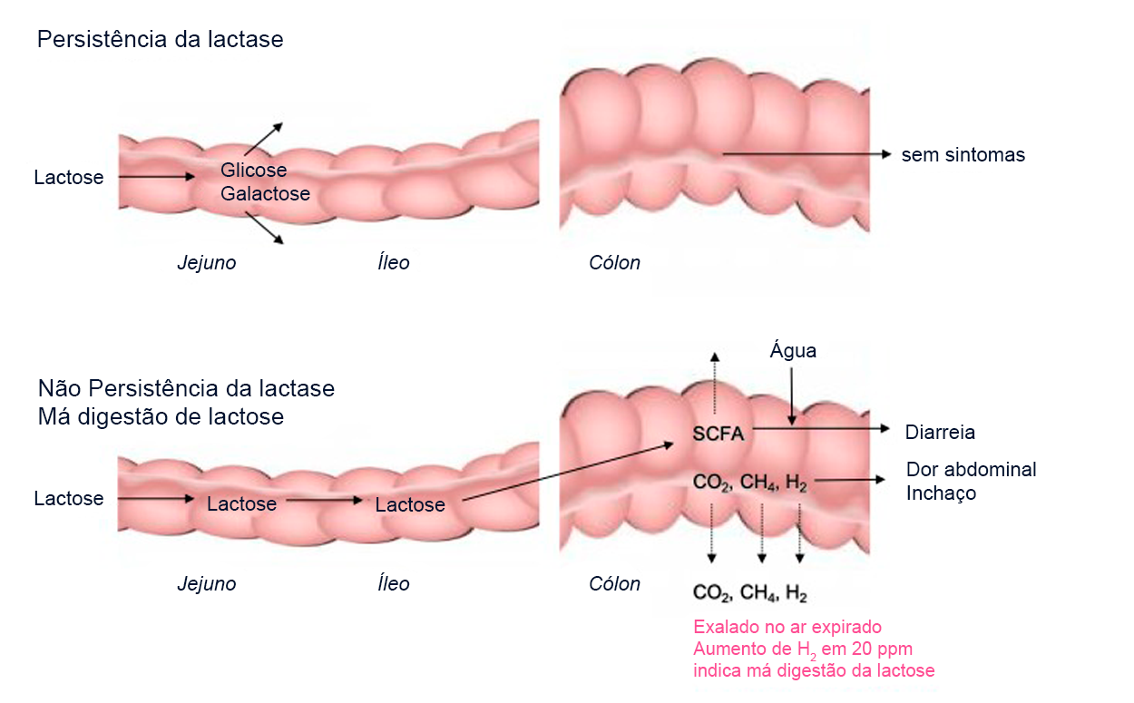 Intolerância à lactose: o que é, tipos, sintomas, como diagnosticar e mais!